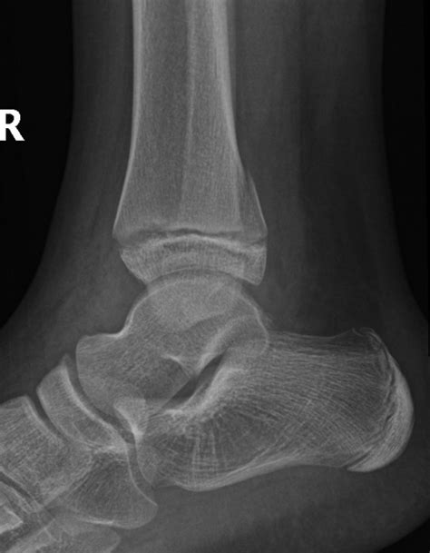 Distal Fibula Growth Plate Fracture