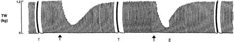 Comparison of spontaneous recovery (left) and edrophonium-accelerated... | Download Scientific ...