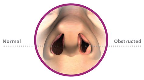 New Non-Invasive Treatment for Nasal Airway Obstruction (Stuffy Nose ...