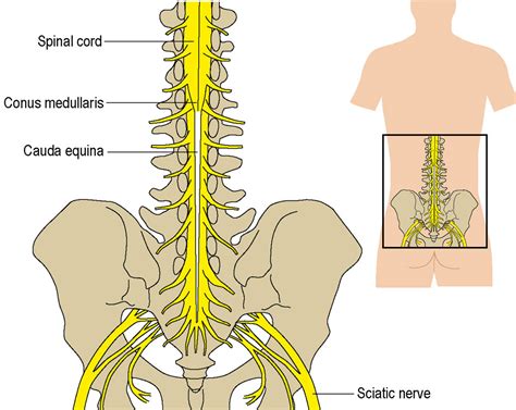 Cauda Equina Syndrome: Symptoms, Causes, Treatment By Back Braces