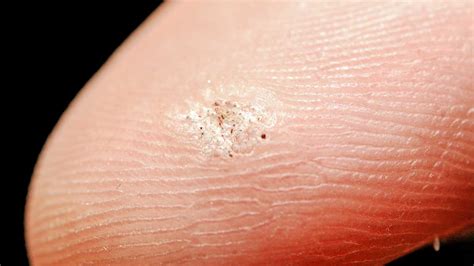 Seed Warts: Contagious, On Fingers, Home Remedies, On Foot