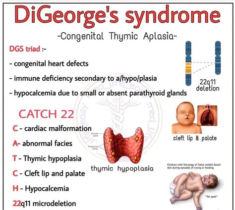 Digeorge's Syndrome Popular Mnemonic- CATCH 22