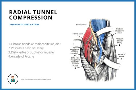 Posterior Interosseous Nerve Syndrome/Palsy - Illustrations, Videos