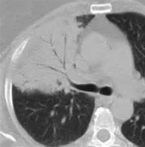 Axial CT scan in lung window setting showing air space consolidation... | Download Scientific ...