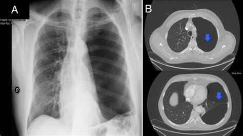 Pulmonary Bleb