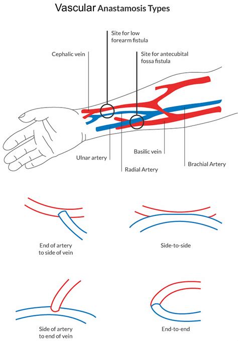 Anastomosis surgery, vascular anastomosis and bowel anastomosis