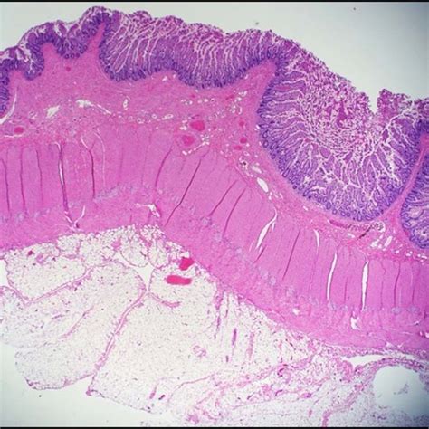 Ileocolic resection showing an edematous terminal ileum with... | Download Scientific Diagram