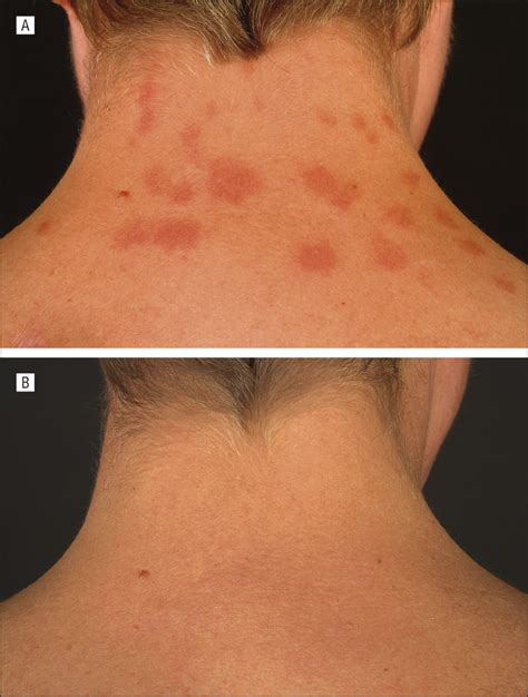 Lupus Erythematosus Tumidus | Dermatology | JAMA Dermatology | The JAMA ...