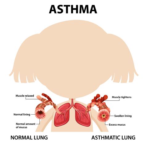 Asthma diagram with normal lung and asthmatic lung 3215388 Vector Art ...