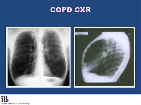 PPT - Ventilation of Patients with COPD and Asthma PowerPoint ...