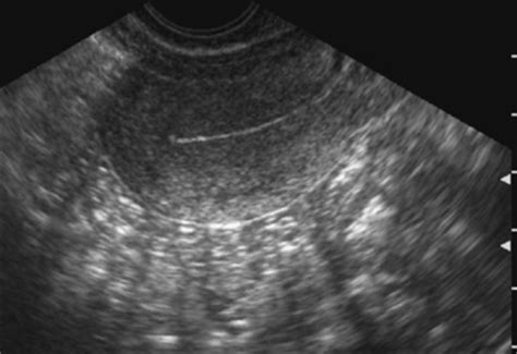 ABNORMAL UTERINE BLEEDING: THE ROLE OF ULTRASOUND | Radiology Key