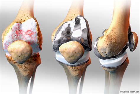 Pin en Knee Replacement