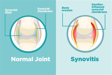 Synovial Membrane Knee