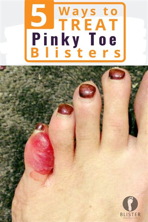 Pin on Foot Injuries