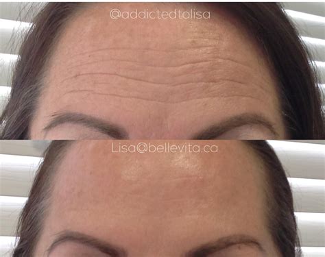 Forehead wrinkles before and after botox - Revive Laser and Skin Clinic