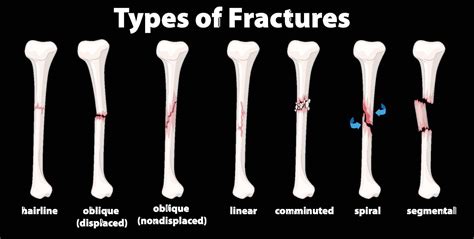 Traduction bombe Faire un effort commutative fracture Médecine légale distance Affiner