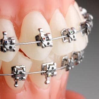 Braces - Platinum Dental Surgery