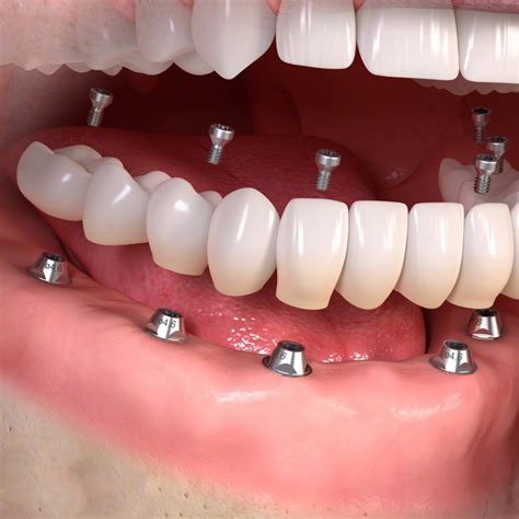 Fixedimplant | 3D Dental & Implant Clinic