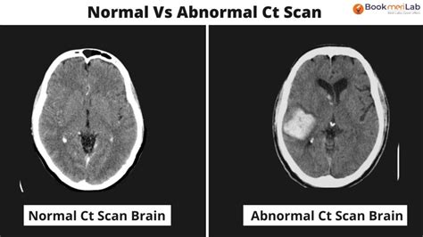 CT Scan Brain: Purpose, Results & Cost [2024] • Bookmerilab