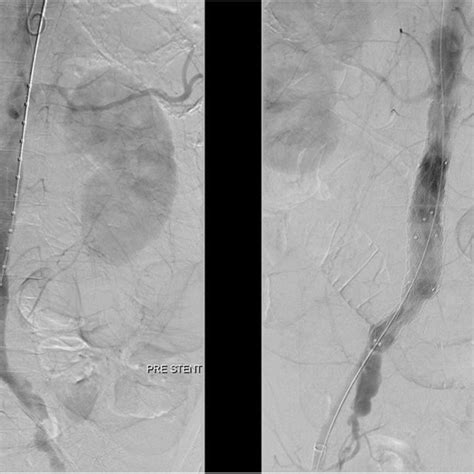 Angiography of aorta demonstrated an infrarenal AAA (white arrow in... | Download Scientific Diagram