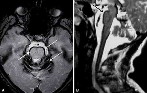 Brain MRI of a patient with superficial siderosis. Axial T2-weighted... | Download Scientific ...