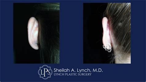 Ear Pinning Before & After Patient 1 - Maryland Plastic Surgeon ...