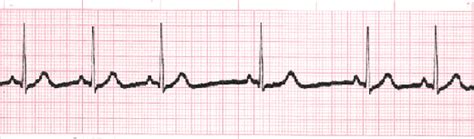 Sinus Rhythms Reference Page - EKG.Academy