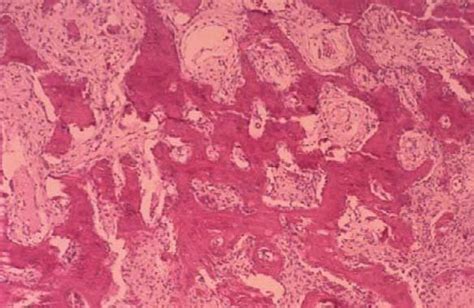 Peripheral Ossifying Fibroma Histology