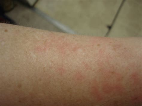 As My Fibro World Turns: Red thick scaly rash photos