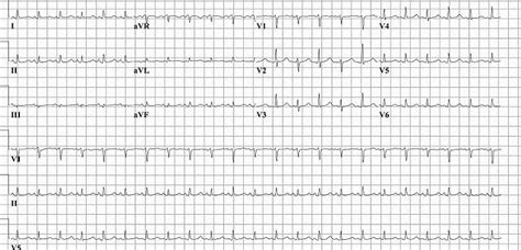 Electrical alternans - wikidoc