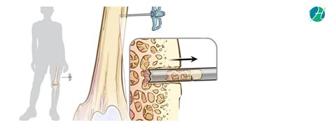 Bone Biopsy – Healthsoul