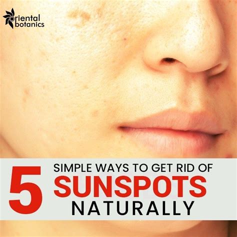 5 Simple Ways To Get Rid Of Sunspots Naturally | Sun spots on skin ...