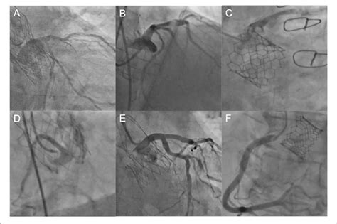 | Coronary engagement in different transcatheter heart valves. (A)... | Download Scientific Diagram