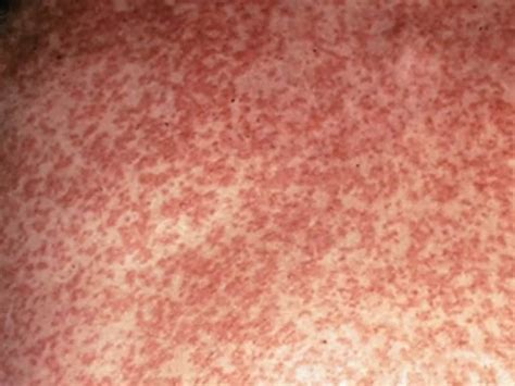 Sydney Measles warning after infected duo return to NSW | News Local