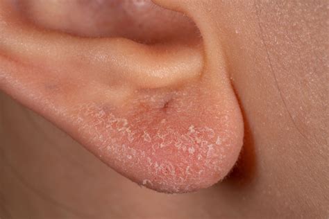 Ear Eczema: Causes, Symptoms, Treatment and Prevention