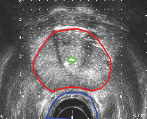 Step 1: Planning your transrectal ultrasound (TRUS) - Sunnybrook Hospital