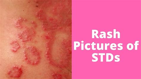 What’s This Rash Pictures of STDs - YouTube