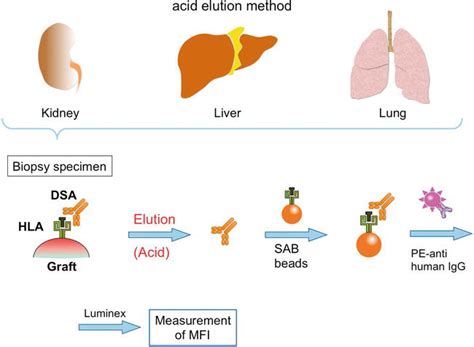 Donor-Specific Anti-HLA Antibodies in Organ Transplantation: Transition ...