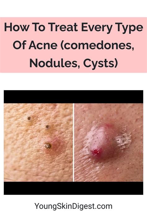 How To Treat Every Type Of Acne (comedones, Nodules, Cysts) | Types of ...