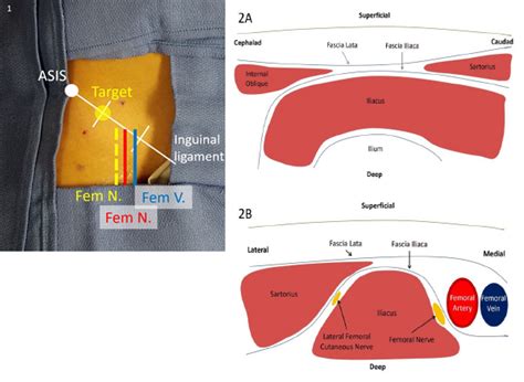 Control Hip Fracture Pain Without Opioids Using Ultrasound-Guided Fascia Iliaca Compartment ...