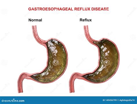 Gastroesophageal Reflux Disease - Failure of the Digestive Mechanism Sphincter that Causes ...