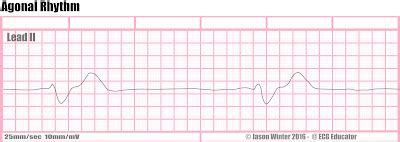 ECG Educator Blog : Agonal Rhythm