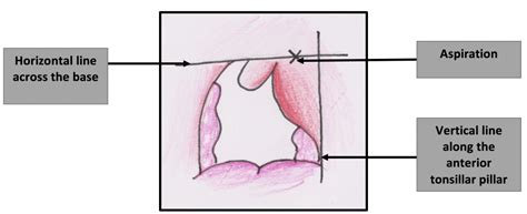 Peritonsillar abscess - Management - TeachMePaediatrics