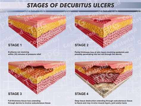 Stages of Decubitus Ulcers - Order