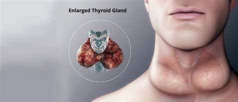 Multinodular Goitre: Overview & Treatment