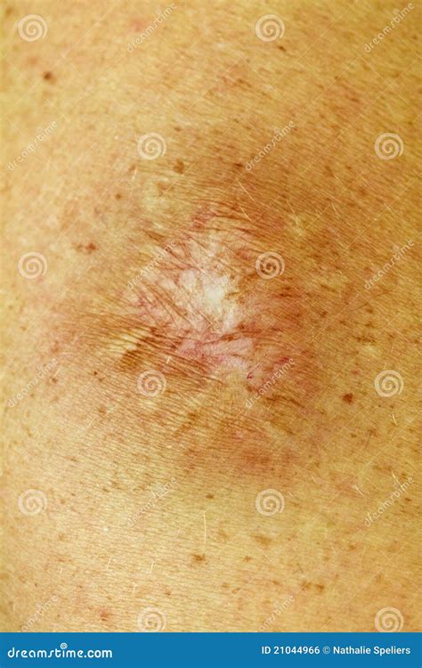 Dog Bite Scar stock photo. Image of stitches, wound, medicine - 21044966