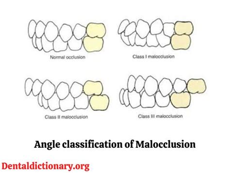 Angle classification of malocclusion - Dental Dictionary