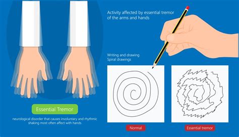 Essential Tremor – Caring Medical Florida