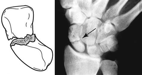 Scaphoid fracture causes, symptoms, diagnosis, treatment & revovery time