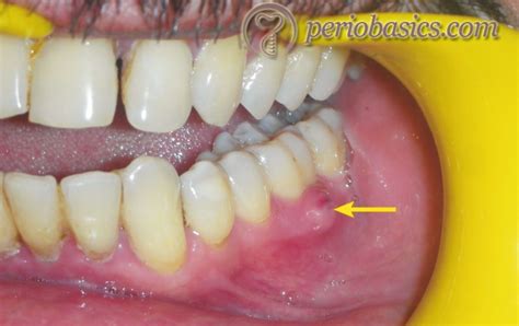 Absceso Apical Agudo